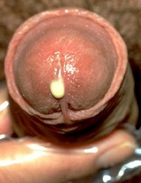 выделения из полового члена при инфекциях мочеполовой системы у мужчин