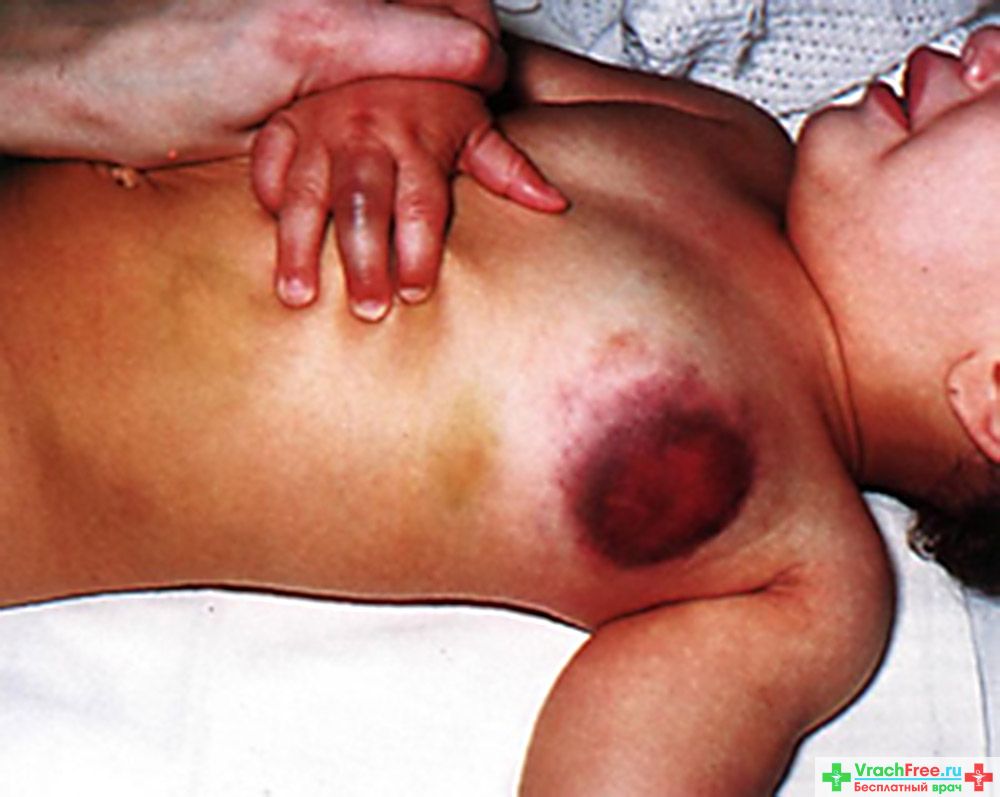 гемофилия у детей, признаки гемофилии детей, вероятность рождения ребенка страдающего гемофилией