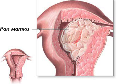 рак эндометрия, рак эндометрия матки, рак эндометрия симптомы