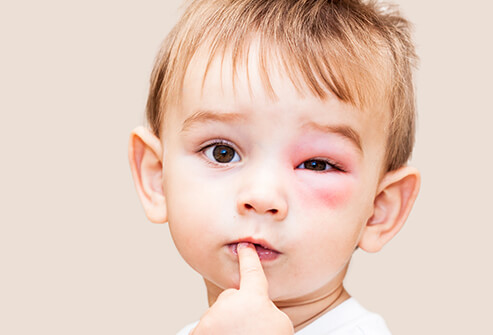 частые аллергены,распространенные аллергены детей, наиболее частые аллергены, распространенные аллергены, самые распространенные аллергены