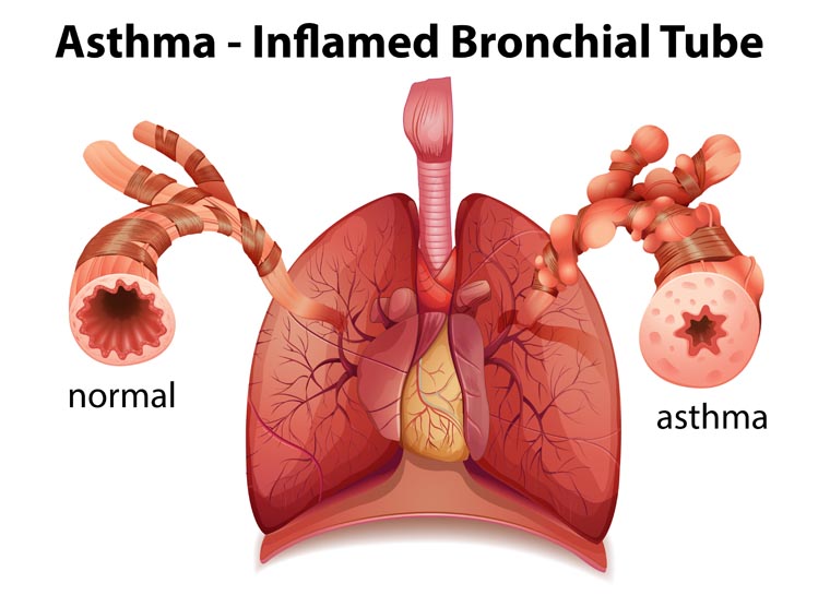 степени бронхиальной астмы, диагноз бронхиальная астма, бронхиальная астма симптомы +у взрослых, бронхиальная астма, бронхиальная астма симптомы, бронхиальная астма +у взрослых
