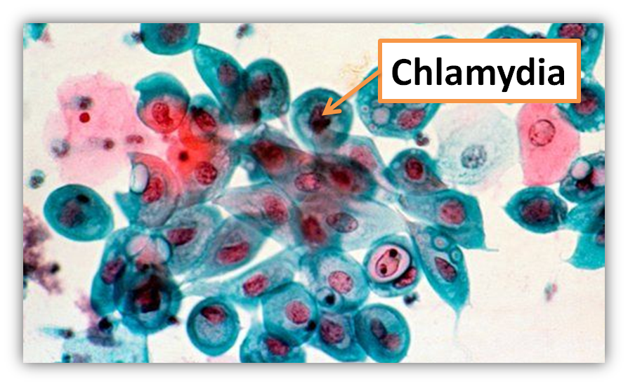 Хламидия берут. Хламидии - возбудители урогенитальных инфекций. Хламидия трахоматис под микроскопом. Возбудитель хламидии микробиология. Урогенитальный хламидиоз микроскопия.