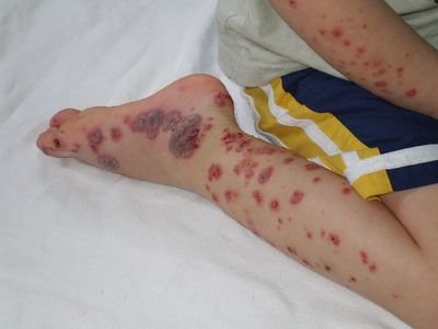 болезнь верльгофа, тромбоцитопеническая пурпура, болезнь верльгофа у детей
