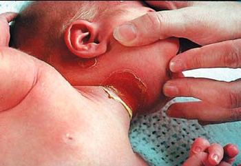 сепсис новорожденных, сепсис новорожденных причины, наиболее частая причина сепсиса у новорожденных