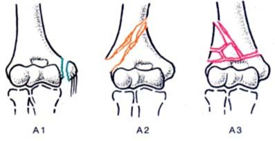 переломы дистального отдела плечевой кости