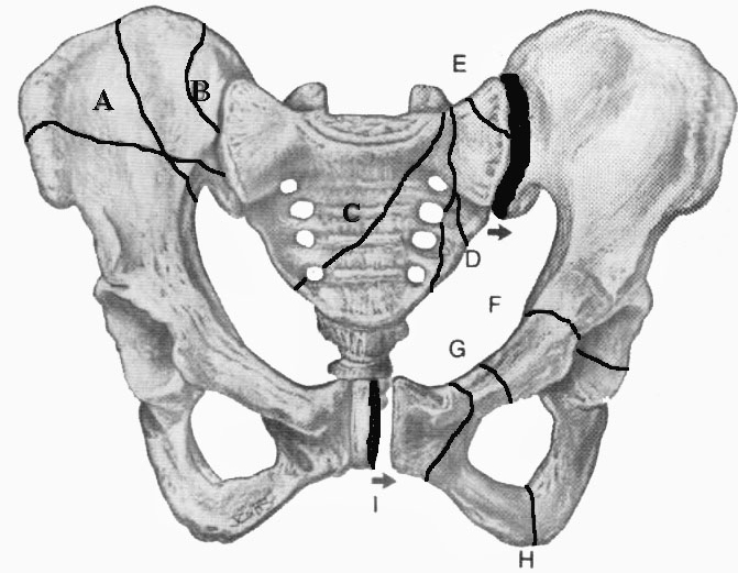 классификация переломов таза, переломы костей таза классификация, кости таза