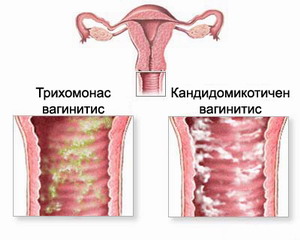 вагинальный кандидоз, молочница, вагинальный кандидоз лечение, вагинальный кандидоз симптомы