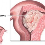 Рак эндометрия