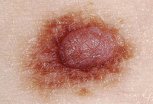 виды рака кожи, рак кожи фото, признаки рака кожи, как выглядит рак кожи, рак кожи, рак кожи начальная стадия фото, рак кожи симптомы
