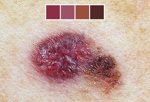 виды рака кожи, рак кожи фото, признаки рака кожи, как выглядит рак кожи, рак кожи, рак кожи начальная стадия фото, рак кожи симптомы