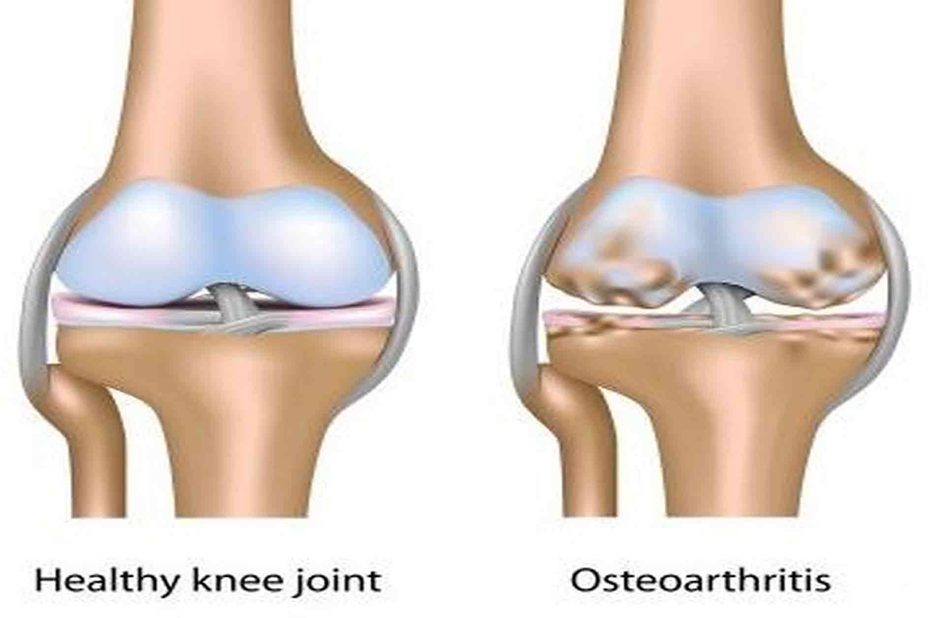 доа, остеоартроз, лечение остеоартрита суставов, сустав воспаление, остеоартрит, остеоартрит суставов, остеоартрит лечение, коленный остеоартрит