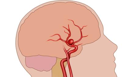 аневризма головного мозга последствия, разрыв аневризмы головного мозга, аневризма головного мозга, аневризма сосудов головного мозга, аневризма головного мозга симптомы,