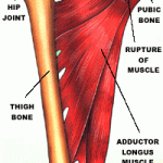 Травмы приводящей мышцы бедра