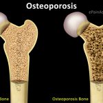 Остеопороз: заблуждения и рекомендации