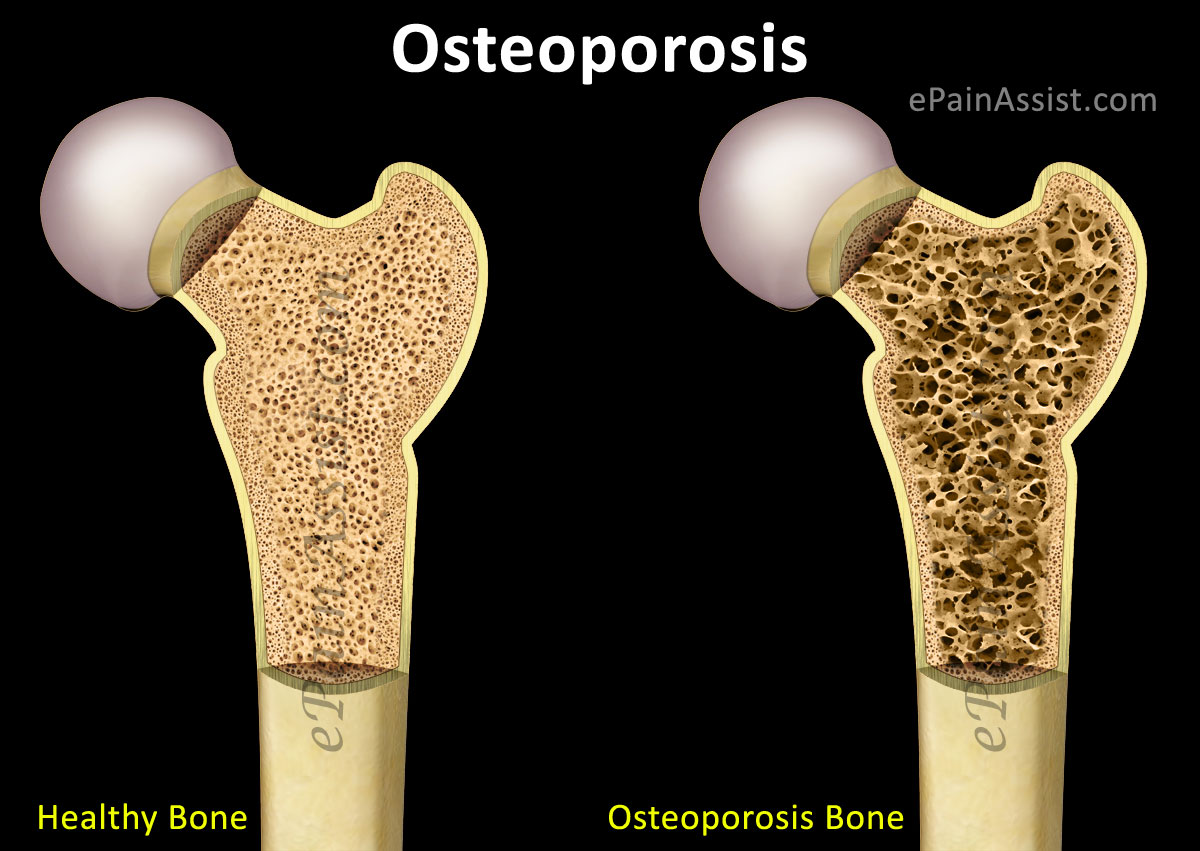 заболевание остеопороз, остеопороз костей, питание +при остеопорозе, кальций +при остеопорозе, остеопороз рекомендации, лечение остеопороза рекомендации, причины остеопороза