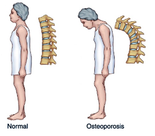 заболевание остеопороз, остеопороз костей, питание +при остеопорозе, кальций +при остеопорозе, остеопороз рекомендации, лечение остеопороза рекомендации, причины остеопороза