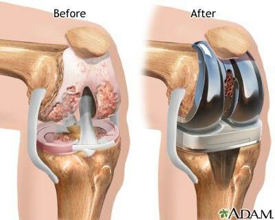 эндопротезирование коленного сустава реабилитация, реабилитация после эндопротезирования